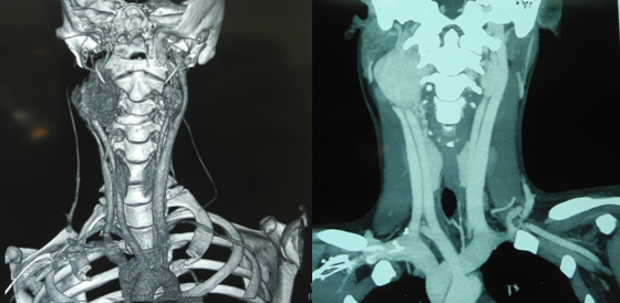 耳鼻咽喉头颈外科治疗颈动脉体瘤取得新突破-西安交通大学第一附属医院