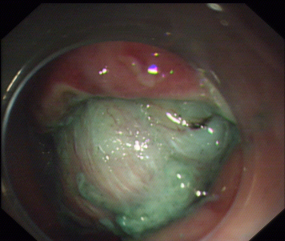 消化内科成功完成一例胃固有肌层巨大肿瘤胃镜下胃壁全层切除术-西安交通大学第一附属医院